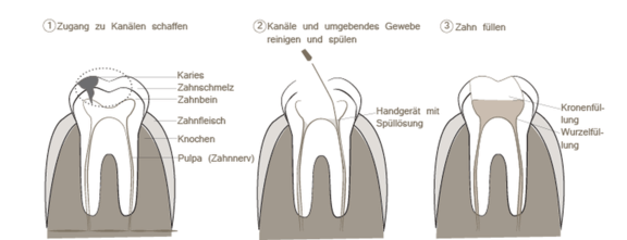 zahnarzt-duesseldorf-wurzelbehandlung-lasertechnologie.png 