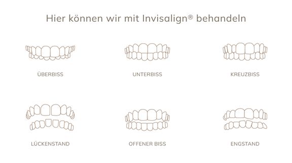 Invisalign Zahnfehlstellungen, ZZD