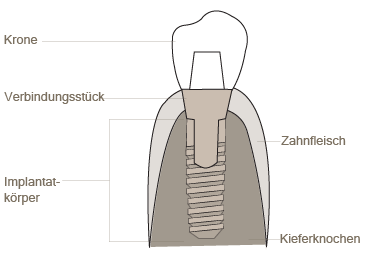 zahnarzt-duesseldorf-aufbau_zahnimplantat.png 